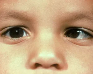 mata juling pada anak